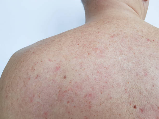 istock birthmark pimples on the back men bad skin 918155142