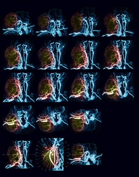 mra (angiografía de resonancia magnética) del cuello - salivary gland fotografías e imágenes de stock