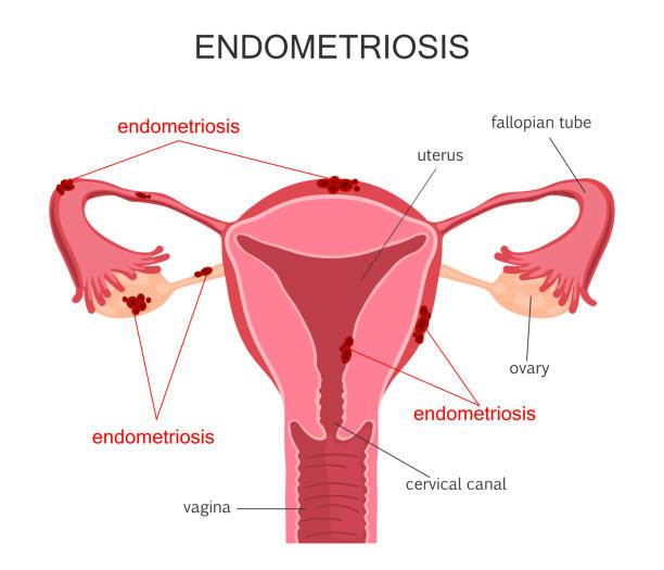 Uterus Endometriosis Diagram Endometriosis diagram. Diseases of the female reproductive system. Vector illustration fallopian tube stock illustrations