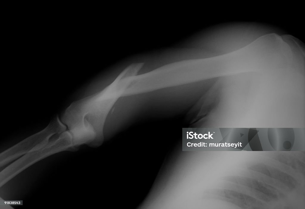 broken arm x-ray  Humerus Stock Photo