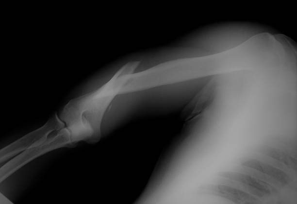 broken arm x-ray stock photo