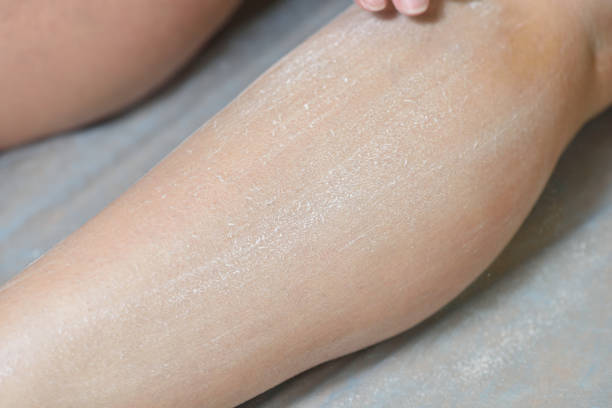 istock Preparation of skin for sugaring 918619086