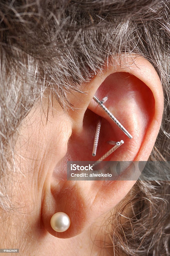 Acupuncture Needling Acupoints On Ear  Acupuncture Stock Photo