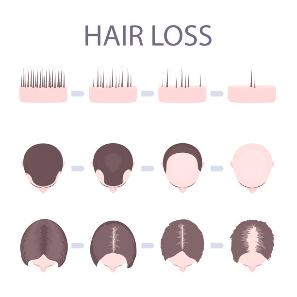 ilustrações, clipart, desenhos animados e ícones de perda de cabelo masculino e feminino - alopecia homem