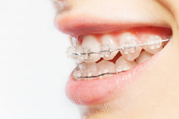 istock Side view picture of teeth with clear braces 918796034
