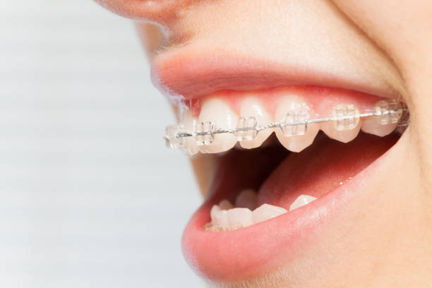 istock Orthodontics correction of jaws with clear bracket 918796052