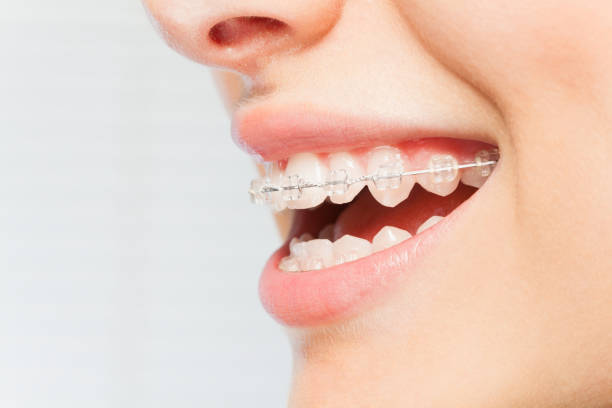 sonrisa de mujer con claras aparatos dentales en los dientes - banda correctora fotografías e imágenes de stock