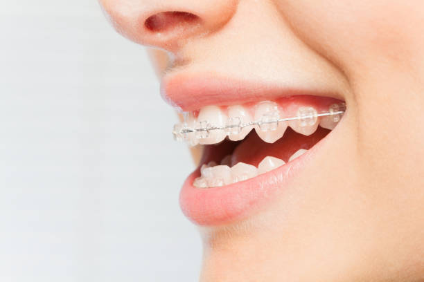Woman's smile with clear dental braces on teeth Side view picture of woman's smile with clear dental braces on teeth against blanked background orthodontist stock pictures, royalty-free photos & images