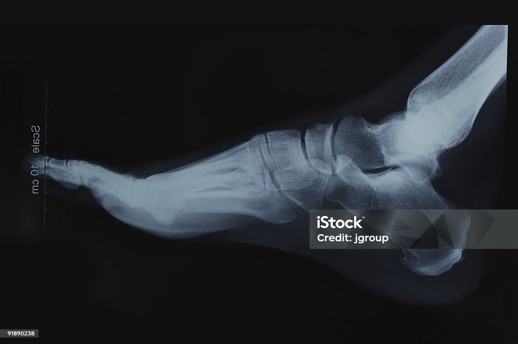 Zdjęcie rentgenowskie stopy - Zbiór zdjęć royalty-free (Anatomia człowieka)