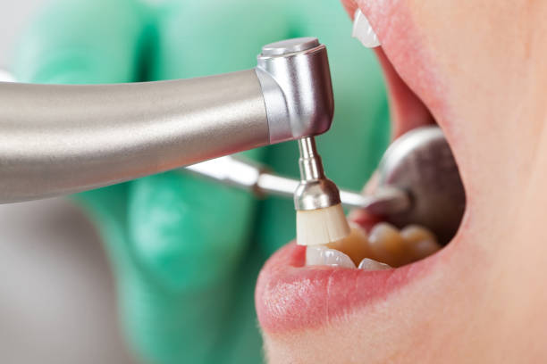 istock Professional dental cleaning 918977838