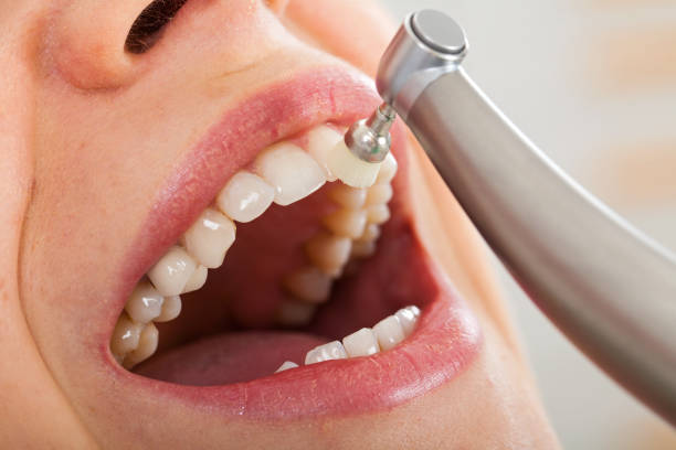 istock Professional dental cleaning 918981090