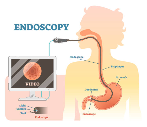 endoskopie anatomische abbildung vektordiagramm, medizinische system. - speiseröhre stock-grafiken, -clipart, -cartoons und -symbole