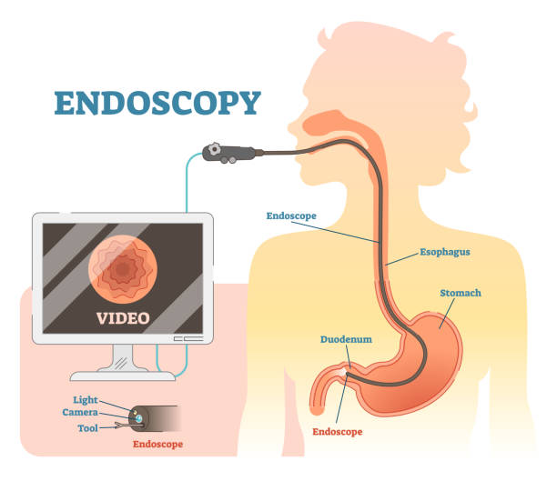 endoskopie anatomische abbildung vektordiagramm, medizinische system. - endoskop stock-grafiken, -clipart, -cartoons und -symbole