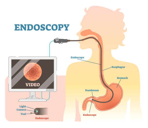 Endoscopy anatomical vector illustration diagram, medical scheme. Endoscopy anatomical vector illustration diagram, medical scheme with endoscope monitoring, esophagus, and stomach. esophagus stock illustrations