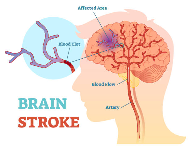 Brain Stroke anatomical vector illustration diagram, scheme Brain Stroke anatomical vector illustration diagram, scheme with brains blood flow and blood clot. cerebrum stock illustrations