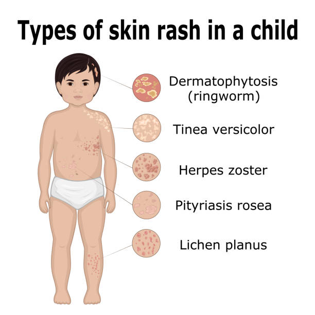 Types of skin rash in a child Five types of skin rashes on the body of a small child tinea stock illustrations