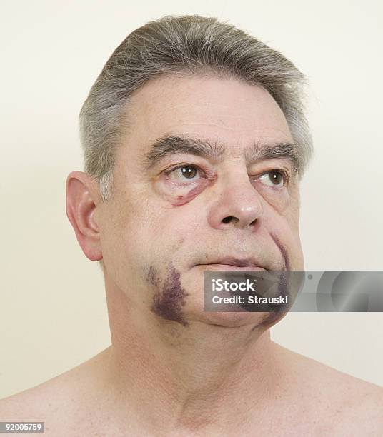 Medical Photo Stock Photo - Download Image Now - Adult, Adults Only, Bruise