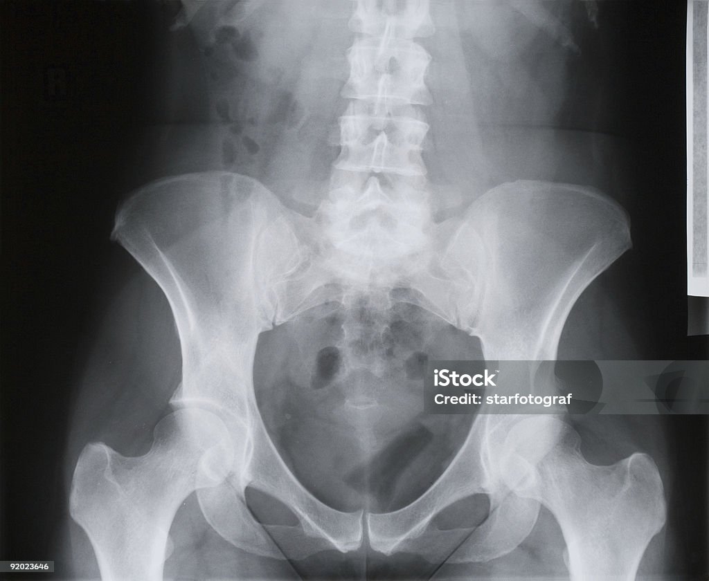 Columna vertebral, pelvis, conector hembra de cadera articular muslo Rayos x óseos, osteoporosis - Foto de stock de Anatomía libre de derechos