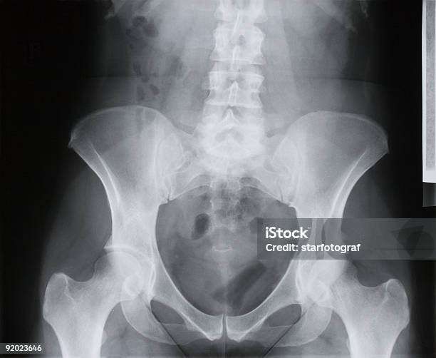 Columna Vertebral Pelvis Conector Hembra De Cadera Articular Muslo Rayos X Óseos Osteoporosis Foto de stock y más banco de imágenes de Anatomía