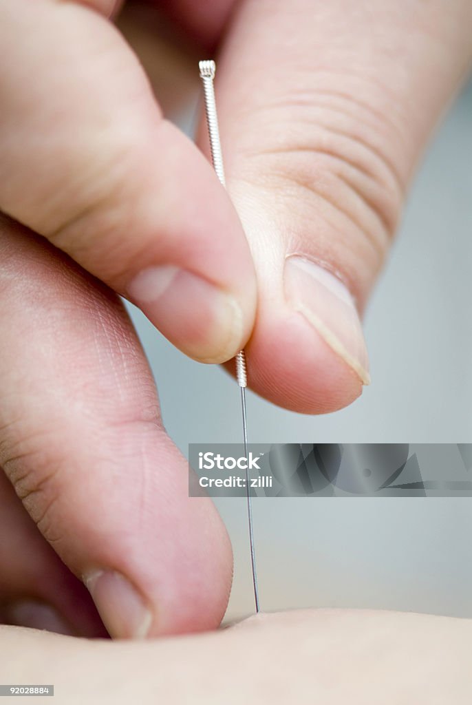 Tratamiento de la acupuntura - Foto de stock de Acupuntura libre de derechos