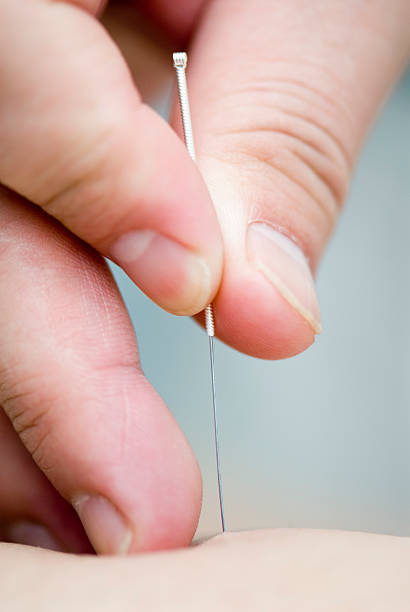 Doctor uses needles for treatment of the patient