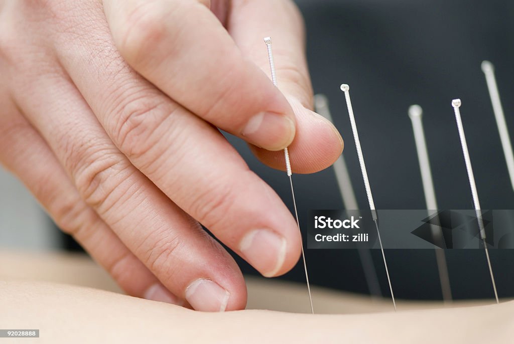 Tratamiento de la acupuntura - Foto de stock de Acupuntura libre de derechos