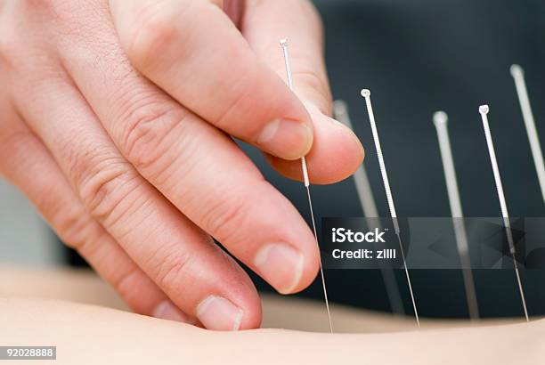 Tratamiento De La Acupuntura Foto de stock y más banco de imágenes de Acupuntura - Acupuntura, Acupunturista, Aguja de acupuntura