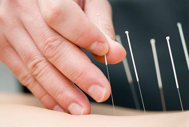 treatment by acupuncture - alternatieve geneeskundige fotos stockfoto's en -beelden