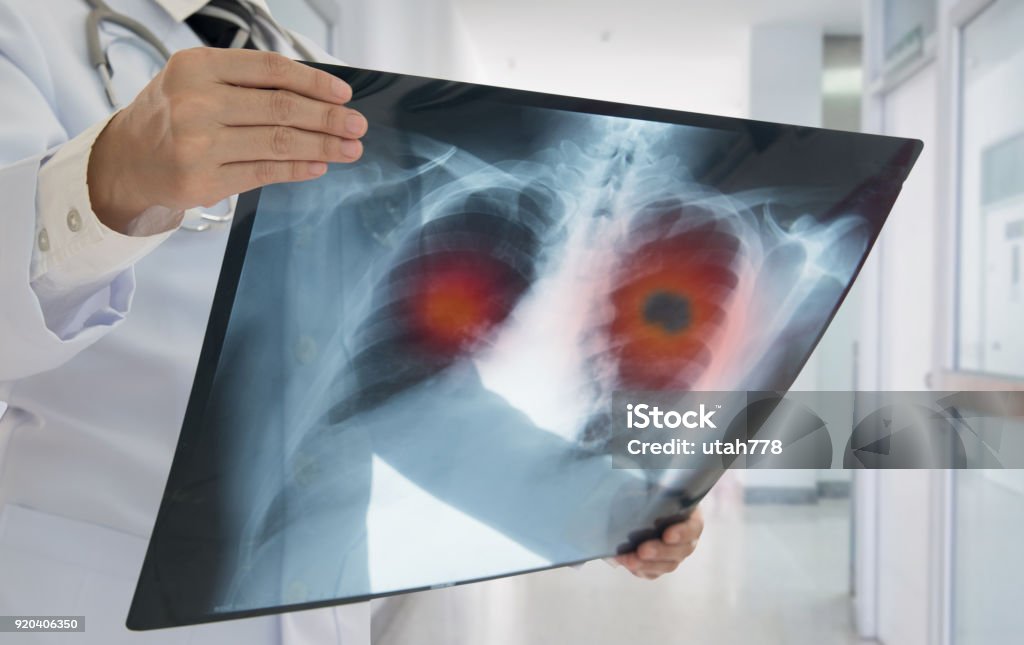 x-ray lung cancer Lung Cancer. Doctor check up x-ray image have problem lung tumor of patient. Lung Cancer Stock Photo