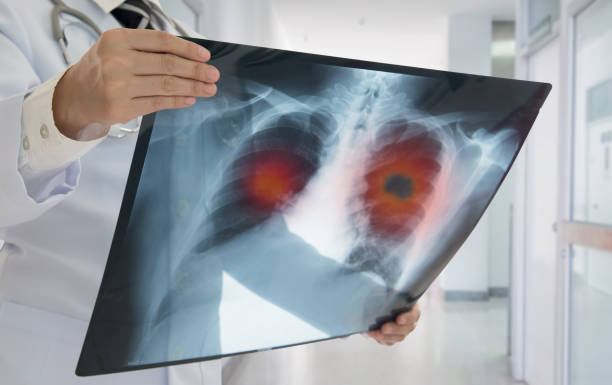 x-ray lung cancer Lung Cancer. Doctor check up x-ray image have problem lung tumor of patient. asthmatic photos stock pictures, royalty-free photos & images