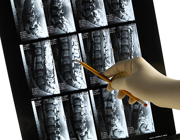 le bas du dos ct scan avec médecin d'excellence d'autrefois de la main & crayon - scoliosis photos et images de collection