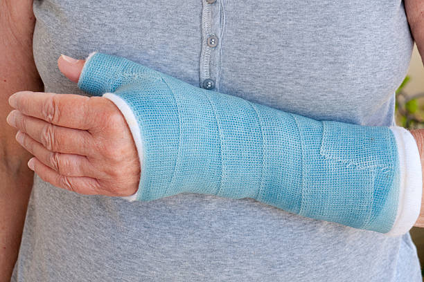 Close-up of woman's arm in blue cast stock photo