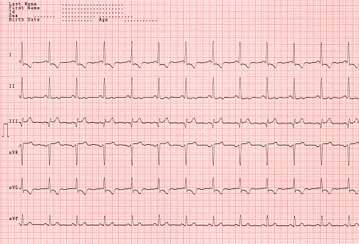 A normal electrocardiogram ECG, 3D illustration displaying the electrical activity of the heart in a healthy individual.