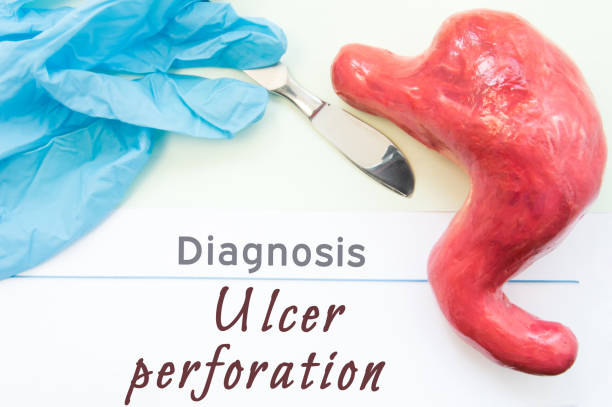 диагностика перфорации язвы. рисунок желудка, скальпеля и хирургических перчаток лежат рядом с названием диагностика язвы перфорации. кон� - scalpel blood paper surgery стоковые фото и изображения