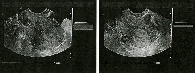 pregnancy ultrasound medical examination image