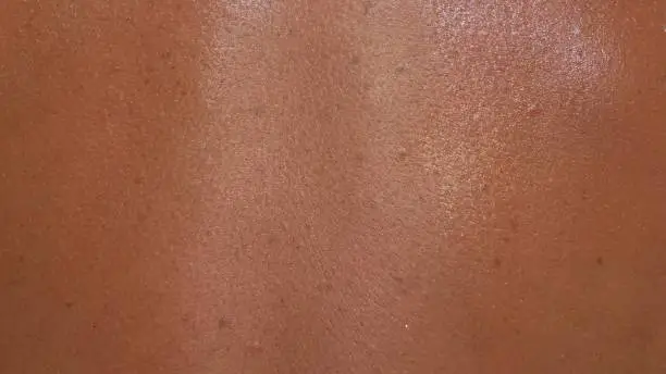 The skin is scorched in the sun with in macro. There are signs of an incipient melanoma.