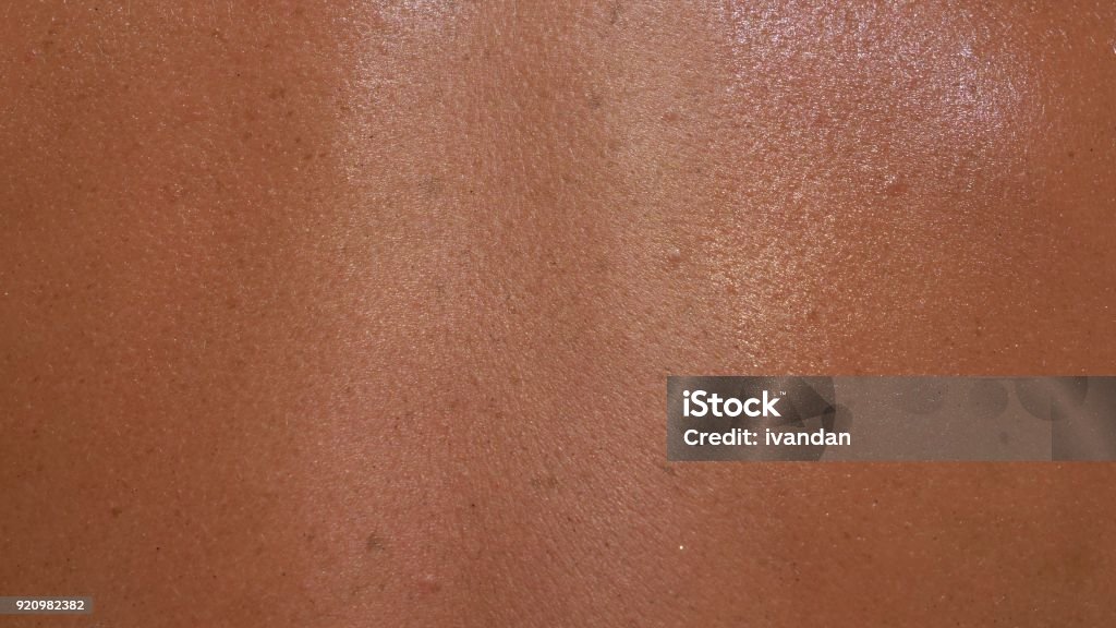 A pele é queimada no sol com em macro. - Foto de stock de Pele royalty-free