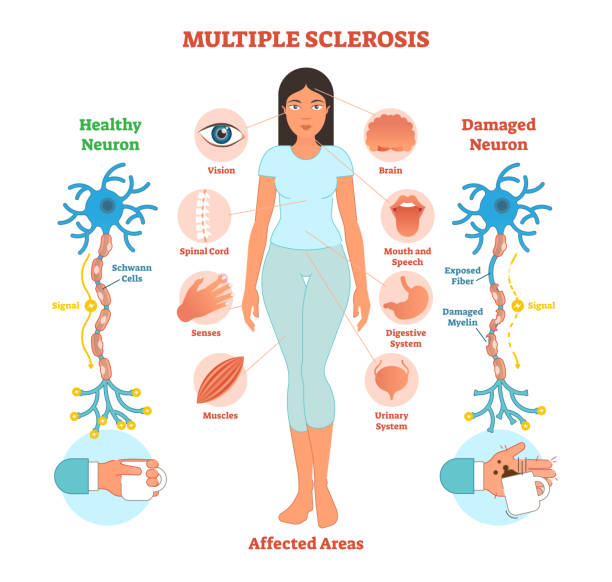 illustrations, cliparts, dessins animés et icônes de diagramme de sclérose en plaques anatomiques vector illustration, régime médical. - spinal nerve