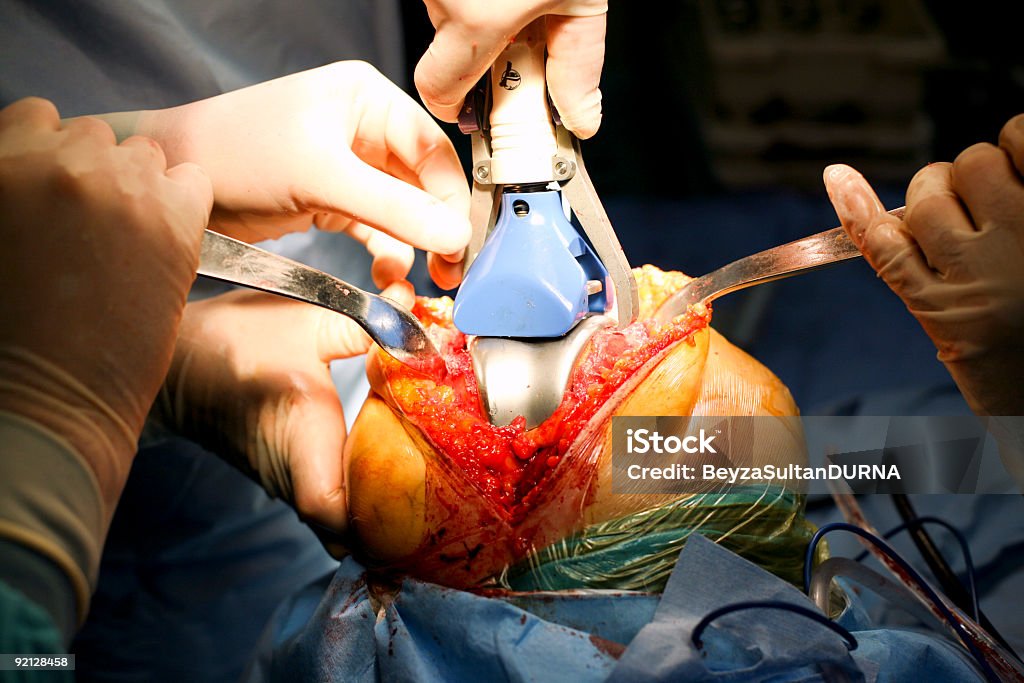 Joelho Prosthesis - Foto de stock de Cirurgia royalty-free