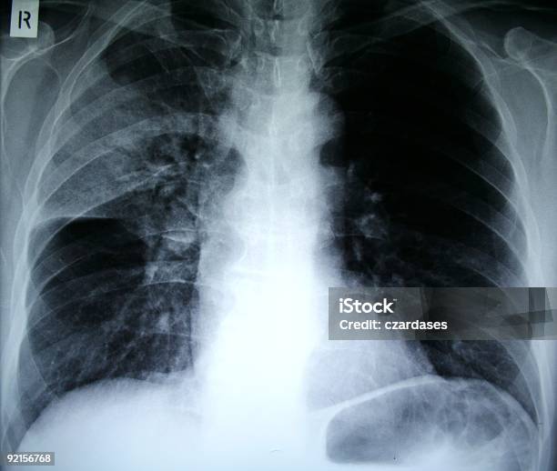 폐렴 X선 X-레이에 대한 스톡 사진 및 기타 이미지 - X-레이, 감기와 독감, 비탄