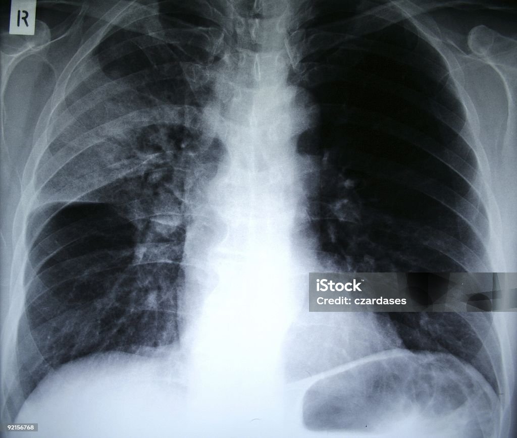 Pneumonia raios X - Foto de stock de Com Falta de Ar royalty-free