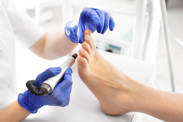 pedicure medica. podologo sviluppa i piedi con una fresatrice. - podiatrist foto e immagini stock