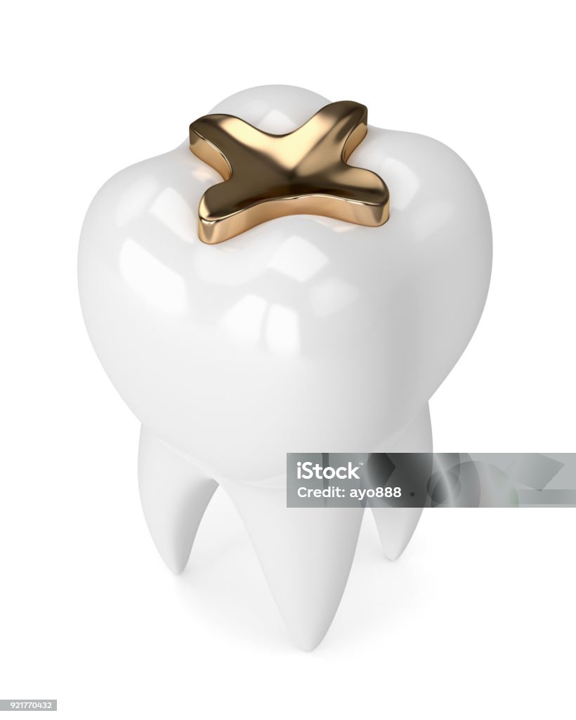 poland3d Rendern des Zahnes mit dental Gold Inlay Füllung - Lizenzfrei Anatomie Stock-Foto