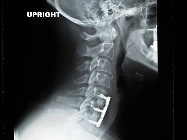 Neck Surgery Xray  surgical pin stock pictures, royalty-free photos & images