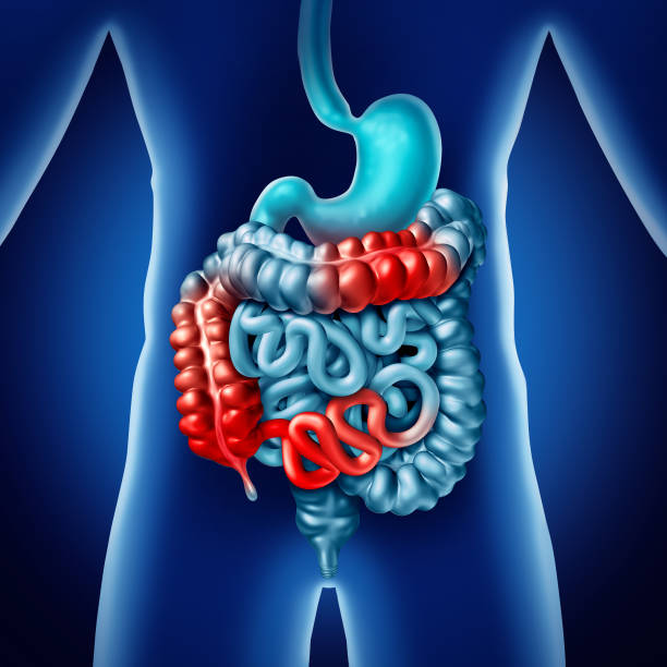 Crohn illness Crohn illness and intestine disease or crohns medical concept as human digestive colon with inflammation symptoms causing obstruction as a 3D illustration. irritable bowel syndrome stock pictures, royalty-free photos & images