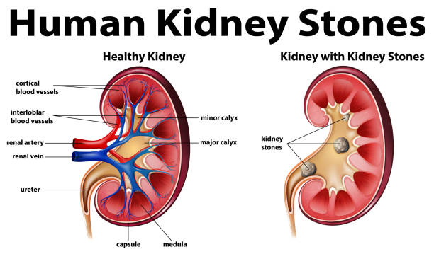 illustrazioni stock, clip art, cartoni animati e icone di tendenza di diagramma di anatomia umana con calcoli renali - kidney stone