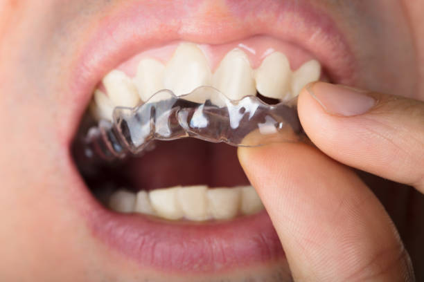 istock Man Adjusting Transparent Aligners In Teeth 922102294