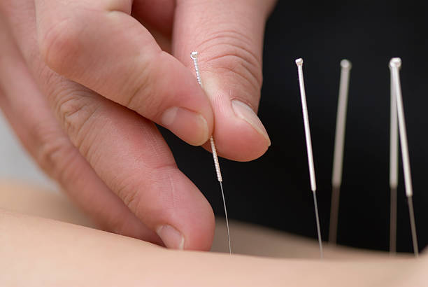Treatment by acupuncture The doctor uses needles for treatment of the patient acupuncture photos stock pictures, royalty-free photos & images