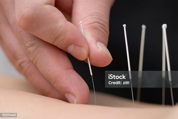 Treatment By Acupuncture Stock Photo - Download Image Now - Acupuncture, Acupuncturist, Close-up