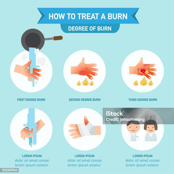 How To Treat A Burn Infographic Stock Illustration - Download Image Now - Burning, Physical Injury, Wound